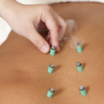 Wat houd de moxeren en cupping behandeling in?